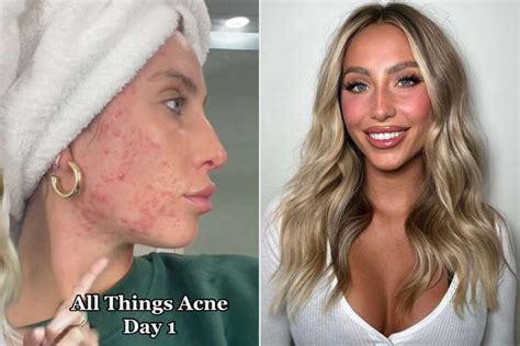 alix earle before accutane|Inside Alix Earles Accutane Journey: The TikTok Star。